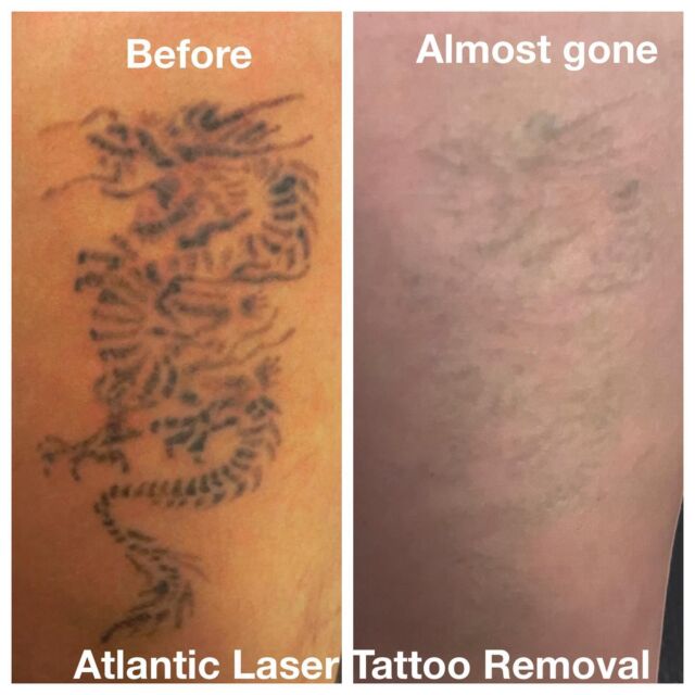 picosure tattoo removal miami