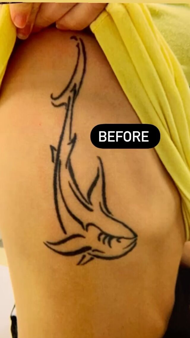 laser tattoo removal aftercare bepanthen