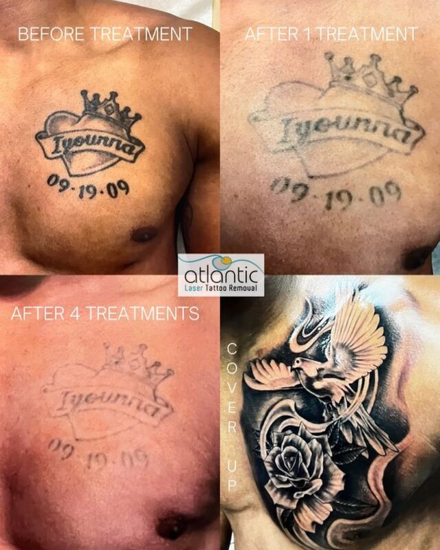 Side Effects Of Tattoo Removal  London Laser