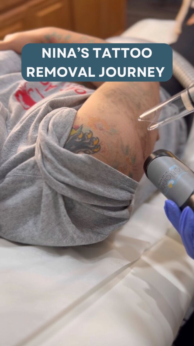 Laser Tattoo Removal Ultimate Guide | Tattoo Removal Institute